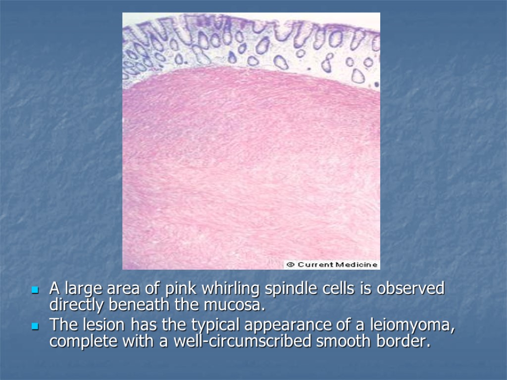 A large area of pink whirling spindle cells is observed directly beneath the mucosa.